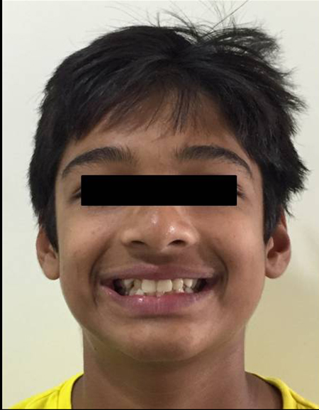Before-Crooked Teeth